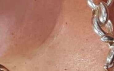 After treatment - Skin Tags