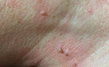 Before treatment - Skin Tags